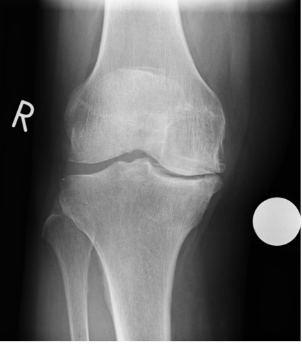 Röntgenbild bevor künstliches Knie eingesetzt wird